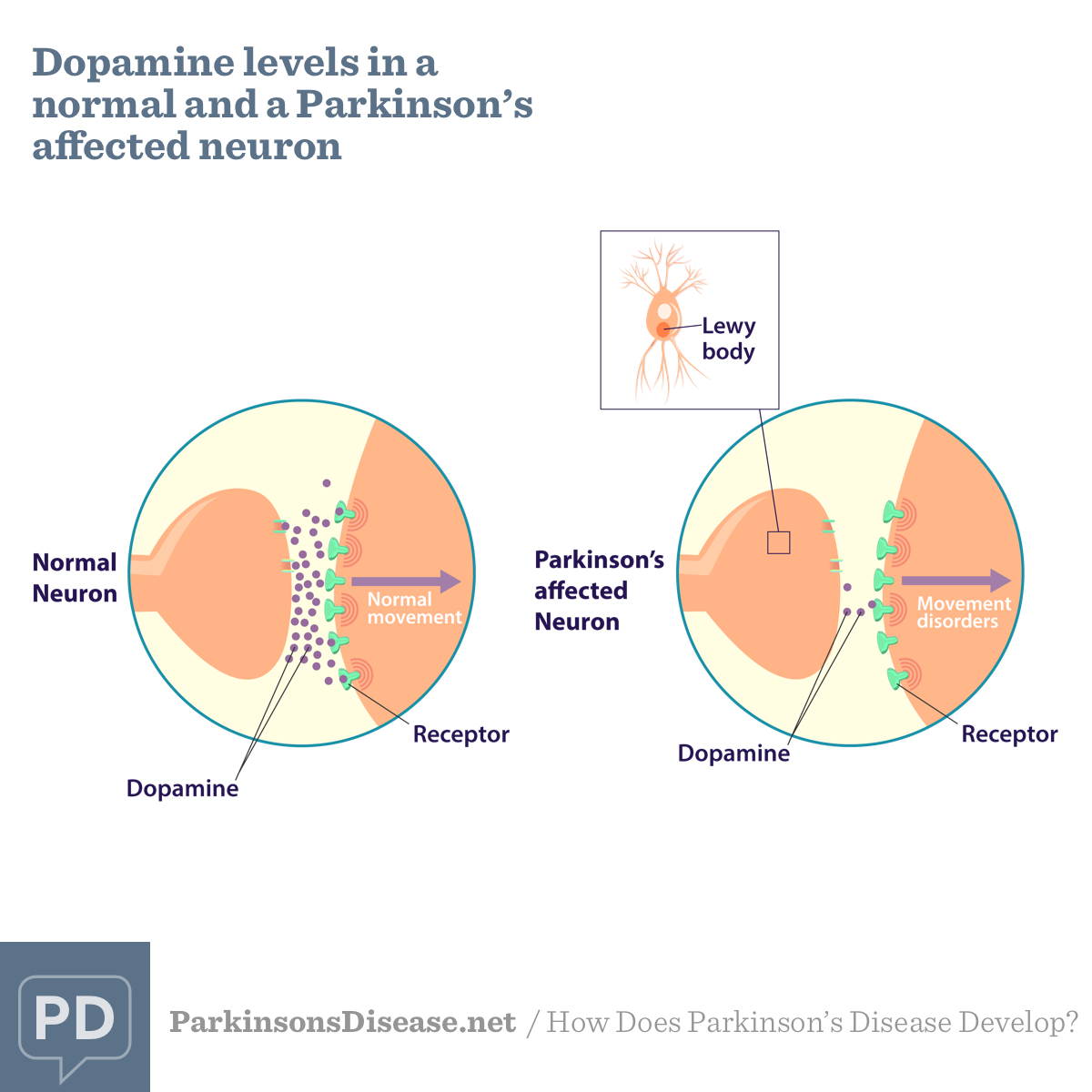 Parkinson's disease and dopamine